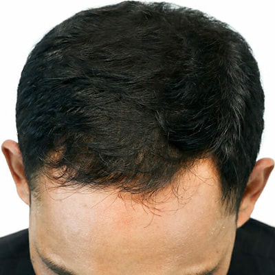 after-img